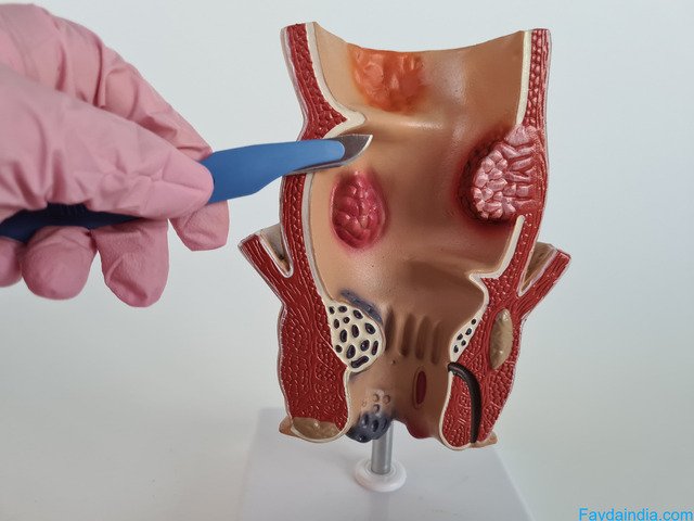 Top Hernia Surgeon In Hanamkonda