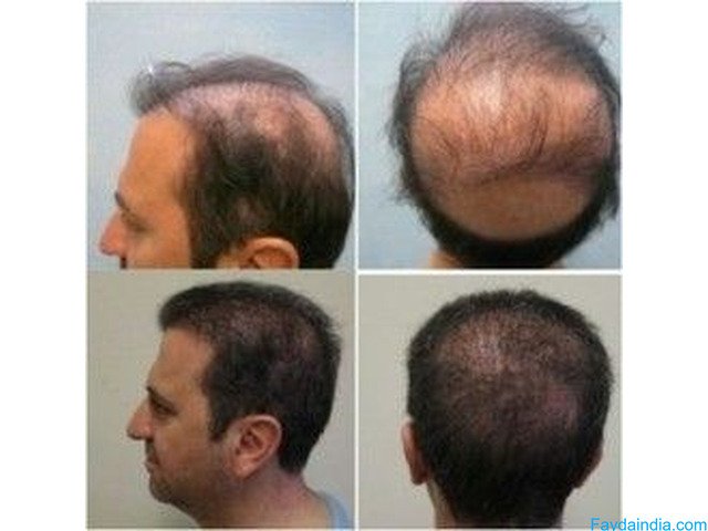 Hair Transplant Treatment in Hanamkonda