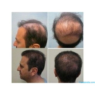 Hair Transplant Treatment in Hanamkonda