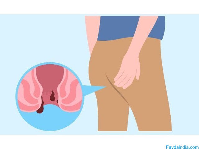 Expert Ano-Rectal Treatment in Noida for Piles & Fissure